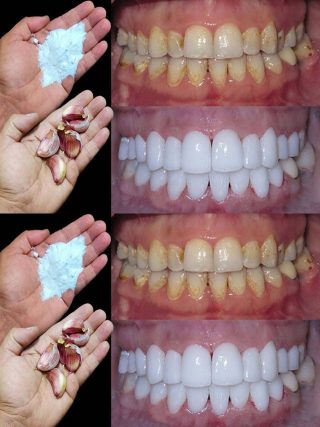 Jak wybielić zęby w 2 minuty?