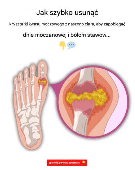Jak szybko usunąć kryształy kwasu moczowego z organizmu, aby zapobiec dnie moczanowej i bólom stawów